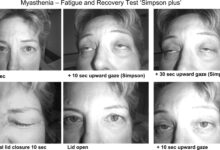 Photo of Что такое глюкометаболический синдром?